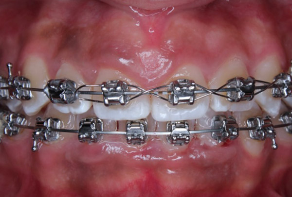 casos-ortodoncia-2-2