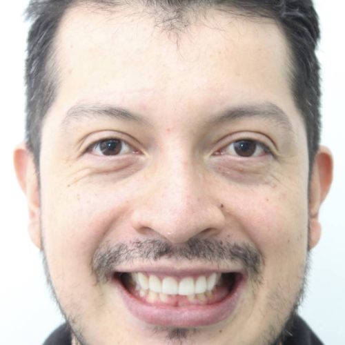 DISEÑO DE SONRISA CALI (3)